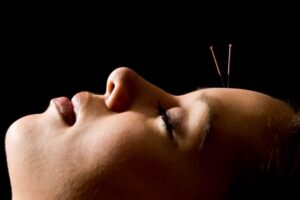 Acupuncture for Anxiety – Stick a Needle in it